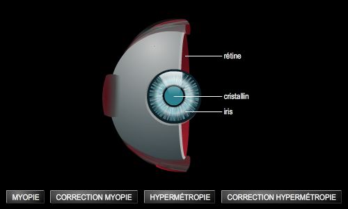 Troubles de la vision, myopie et hypermétropie