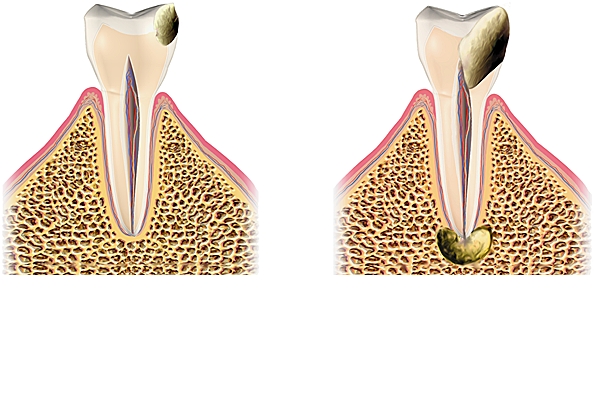 Évolution d'une carie dentaire