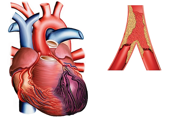 Infarctus du myocarde