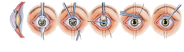 Opération de la cataracte