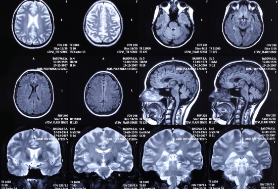 scanner du cerveau scanner du cerveau