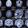 scanner du cerveau
